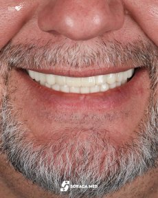 Résultat des implants dentaires All-on-4 chez Soraca Med – sourire naturel restauré