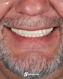 Résultat des implants dentaires All-on-4 chez Soraca Med – sourire naturel restauré