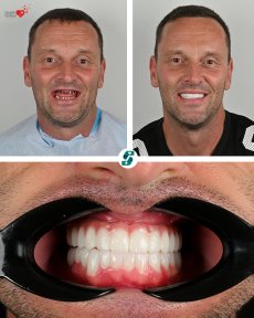 Résultat avant/après implants All-on-4 chez Soraca Med, restauration complète du sourire