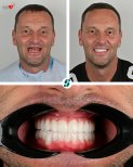 Résultat avant/après implants All-on-4 chez Soraca Med, restauration complète du sourire