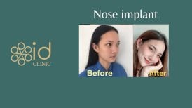 Resultados antes y después de implante nasal en ID Clinic Bangkok, forma de nariz mejorada
