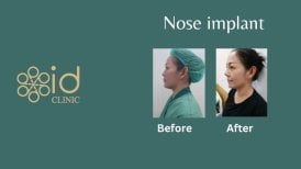 Resultados antes y después de implante nasal en ID Clinic Bangkok, perfil de nariz mejorado
