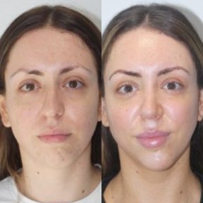 Before and after chin implant results at Hisar Hospital Intercontinental, enhanced chin contour