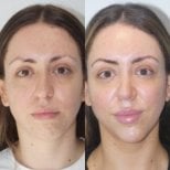 Before and after chin implant results at Hisar Hospital Intercontinental, enhanced chin contour