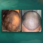 Результати пересадки волосся в Grand Clinic: до і після, відновлена густота волосся