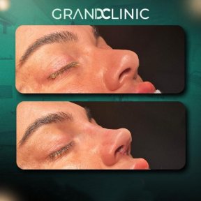 Résultat avant et après rhinoplastie à Grand Clinic, forme et profil du nez améliorés