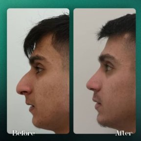 Résultats avant et après rhinoplastie à Grand Clinic, forme et profil du nez améliorés