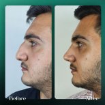 Résultats avant et après rhinoplastie à Grand Clinic, forme et profil du nez améliorés