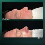 Résultats avant et après rhinoplastie à Grand Clinic, forme et profil du nez améliorés