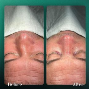 Résultats avant et après rhinoplastie à Grand Clinic, forme et symétrie du nez améliorées