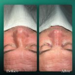 Résultats avant et après rhinoplastie à Grand Clinic, forme et symétrie du nez améliorées