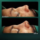 Résultats avant et après rhinoplastie à Grand Clinic, forme et profil du nez améliorés