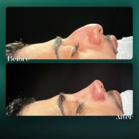 Résultats avant et après rhinoplastie à Grand Clinic, forme et profil du nez améliorés
