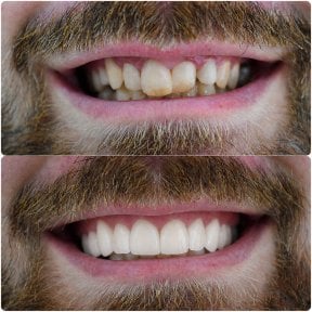 Before and after zirconia crown installation results at Spanderashvili Dental Clinic, smile makeover