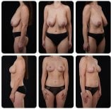 Before and after breast lift results at Yurchenko Plastic Surgery Team Kyiv, improved breast shape