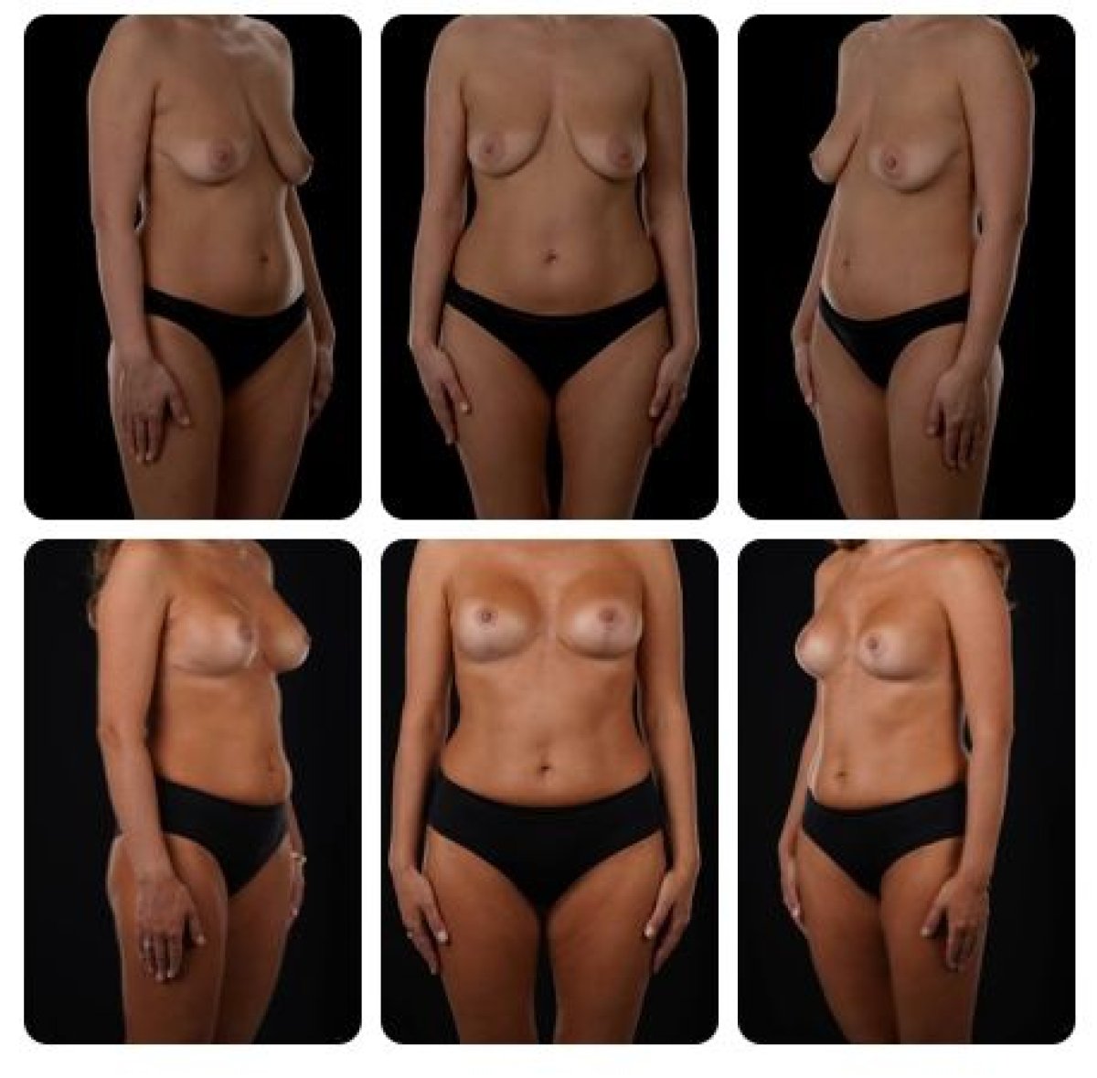 نتائج شد الثدي قبل وبعد في Yurchenko Plastic Surgery Team Kyiv، تحسين الشكل