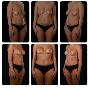 Before and after breast lift results at Yurchenko Plastic Surgery Team Kyiv, improved contour