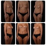 Before and after breast lift results at Yurchenko Plastic Surgery Team Kyiv, improved contour