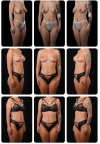 Résultats avant/après lifting mammaire chez Yurchenko Plastic Surgery Team Kyiv, contour amélioré