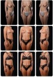 Résultats avant/après lifting mammaire chez Yurchenko Plastic Surgery Team Kyiv, contour amélioré