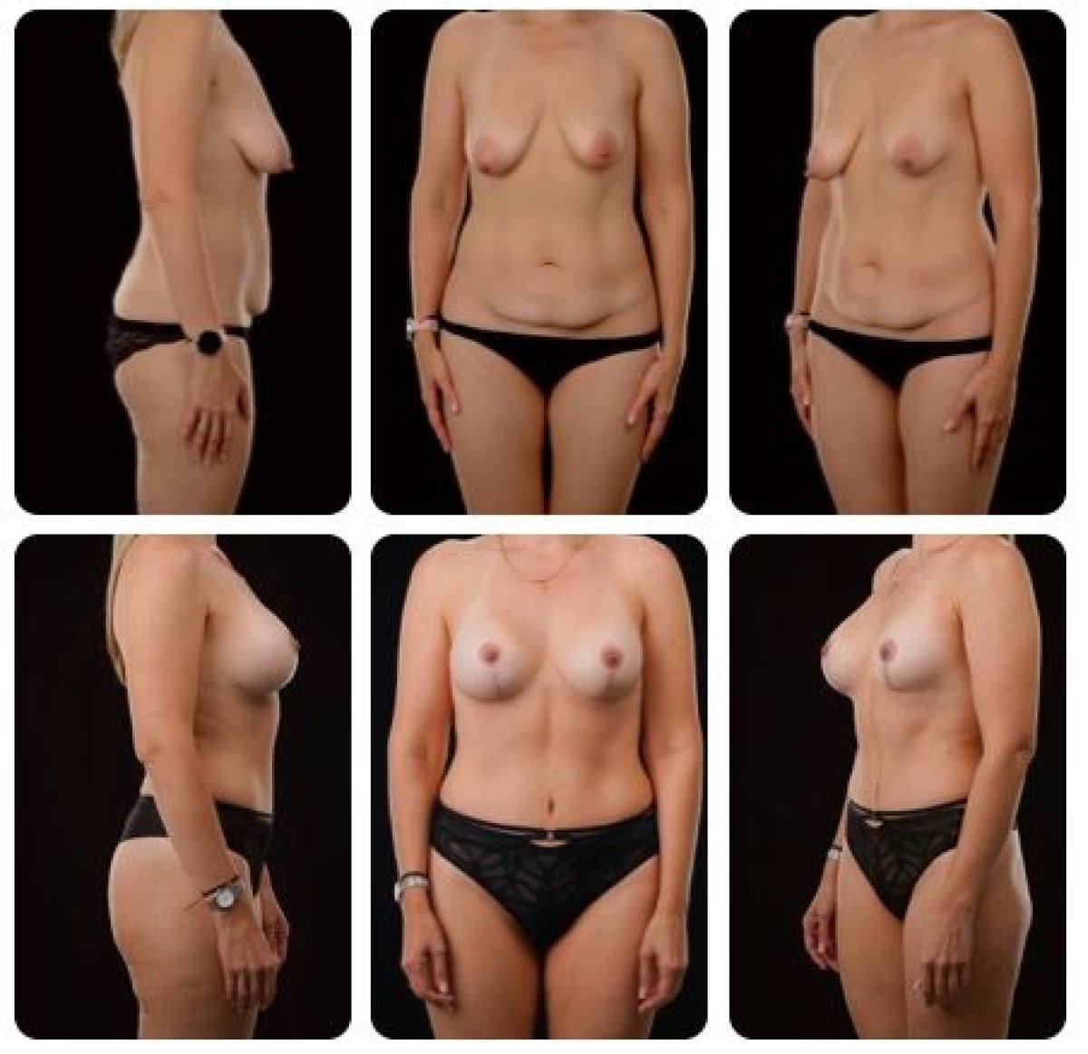 نتائج شد الثدي قبل وبعد في Yurchenko Plastic Surgery Team Kyiv، تحسين الشكل