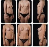 Результаты до и после подтяжки груди в Yurchenko Plastic Surgery Team, улучшенный контур