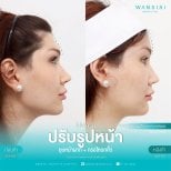 До и после контурной пластики лица в Wansiri Hospital, видимый результат коррекции челюсти и бровей