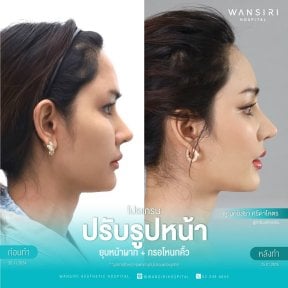 Результаты ринопластики до и после в Wansiri Hospital, коррекция носа и профиля