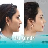 Результаты ринопластики до и после в Wansiri Hospital, коррекция носа и профиля