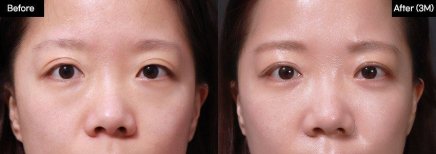 Результат до і після ендоскопічної підтяжки обличчя у VG Plastic Surgery, омолодження