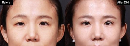 Результати до і після операції на опущених повіках у VG Plastic Surgery, покращення повік