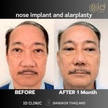 Resultados antes y después de implante nasal y alarplastia en ID Clinic Bangkok, 1 mes