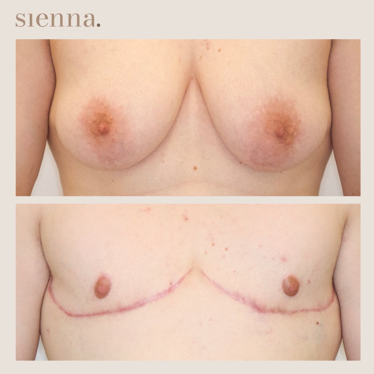 نتائج جراحة الصدر قبل وبعد في Sienna Clinic – تحول تذكير الصدر