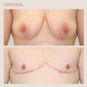 Résultats avant/après top surgery à la Sienna Clinic – masculinisation de la poitrine