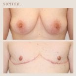 Résultats avant/après top surgery à la Sienna Clinic – masculinisation de la poitrine