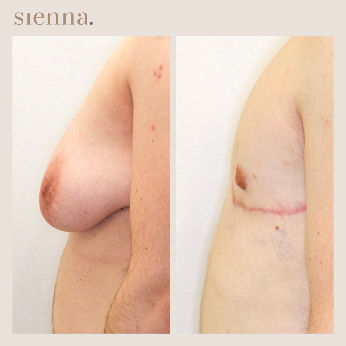 نتائج عملية توب سيرجري قبل وبعد في Sienna Clinic – تحويل الصدر للذكورة
