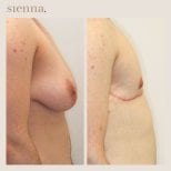 Résultats avant/après top surgery à la Sienna Clinic – masculinisation du torse
