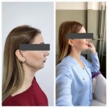 Résultats avant et après réduction des pommettes à Memorial Bahçelievler Hospital, remodelage du visage
