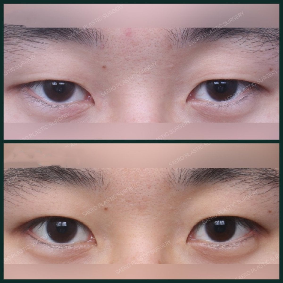 Resultados antes y después de cirugía de doble párpado en SAERO Plastic Surgery, contorno mejorado