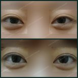 Before and after double eyelid surgery results at SAERO Plastic Surgery, enhanced eye contour