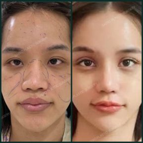 Before and after double eyelid surgery results at SAERO Plastic Surgery, enhanced eye contour