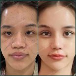 Before and after double eyelid surgery results at SAERO Plastic Surgery, enhanced eye contour