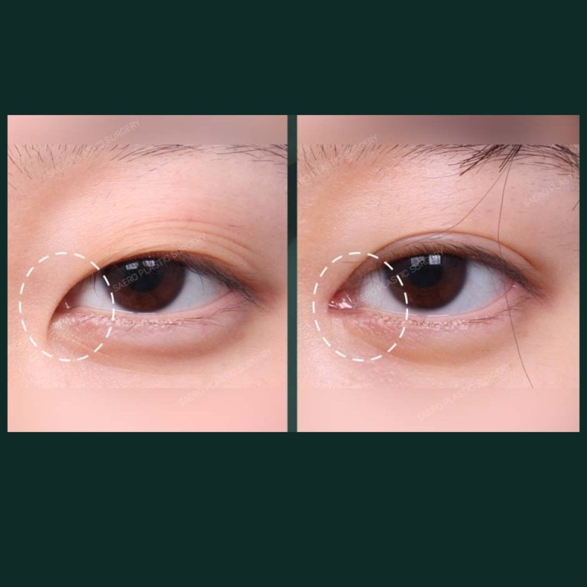 Resultados de blefaroplastia de párpado inferior antes y después en SAERO Plastic Surgery
