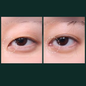Vorher-nachher-Ergebnisse der Unterlid-Blepharoplastik bei SAERO Plastic Surgery, Augenverjüngung