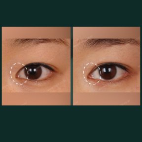 Vorher-nachher-Ergebnis Unterlid-Blepharoplastik bei SAERO Plastic Surgery, Augenverjüngung