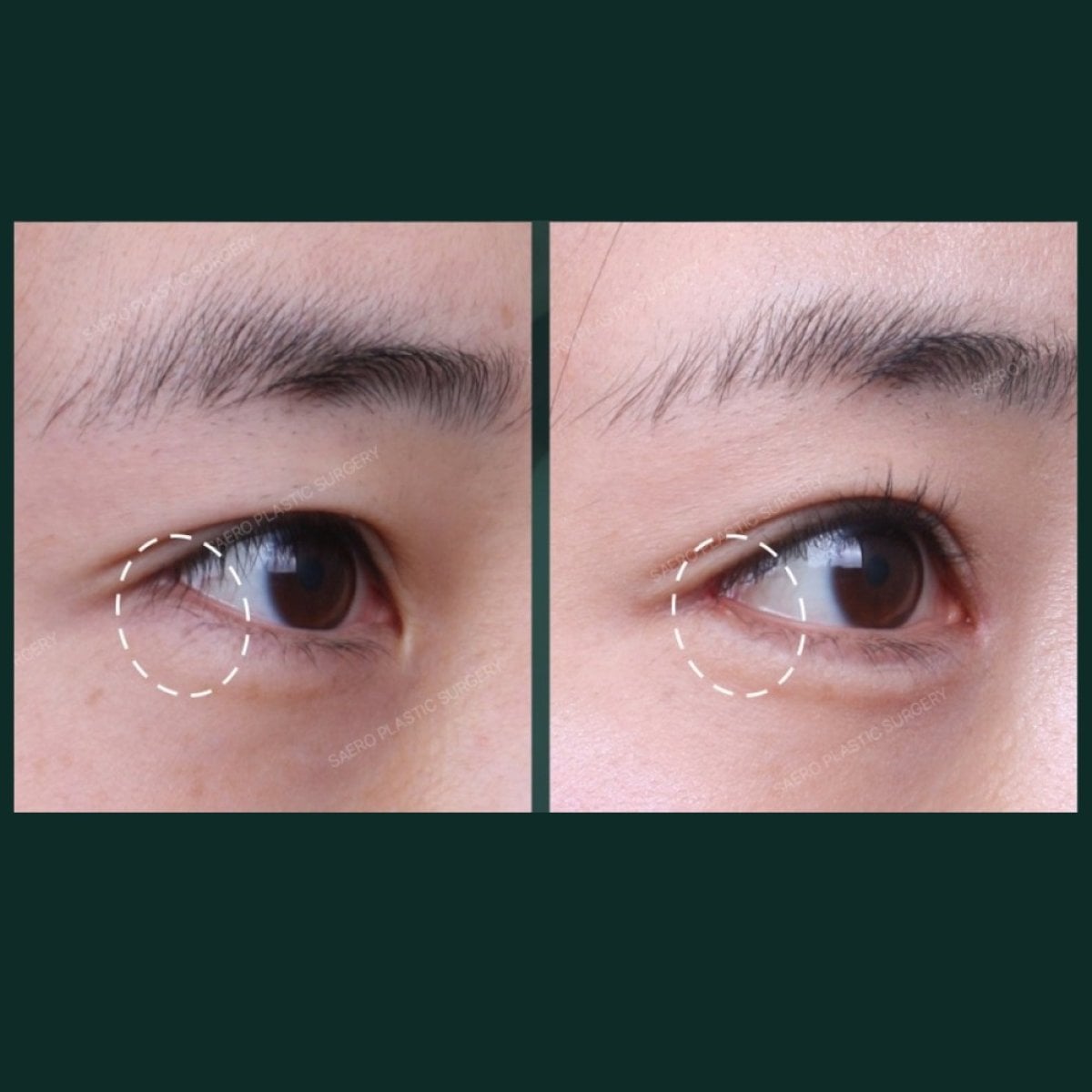 Resultados de blefaroplastia de párpado inferior antes y después en SAERO Plastic Surgery