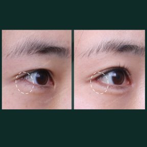 Vorher-nachher-Ergebnisse der Unterlid-Blepharoplastik bei SAERO Plastic Surgery, Augenverjüngung
