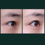 Vorher-nachher-Ergebnisse der Unterlid-Blepharoplastik bei SAERO Plastic Surgery, Augenverjüngung