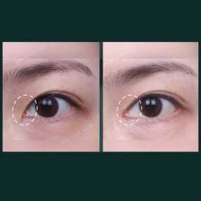 Vorher-nachher-Ergebnisse der Unterlidblepharoplastik bei SAERO Plastic Surgery, Augenverjüngung