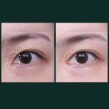 Vorher-nachher-Ergebnisse der Unterlidblepharoplastik bei SAERO Plastic Surgery, Augenverjüngung